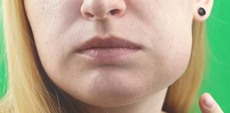 Facial Swelling and Dental Infection