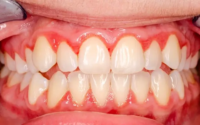 Symptoms of Gingivitis